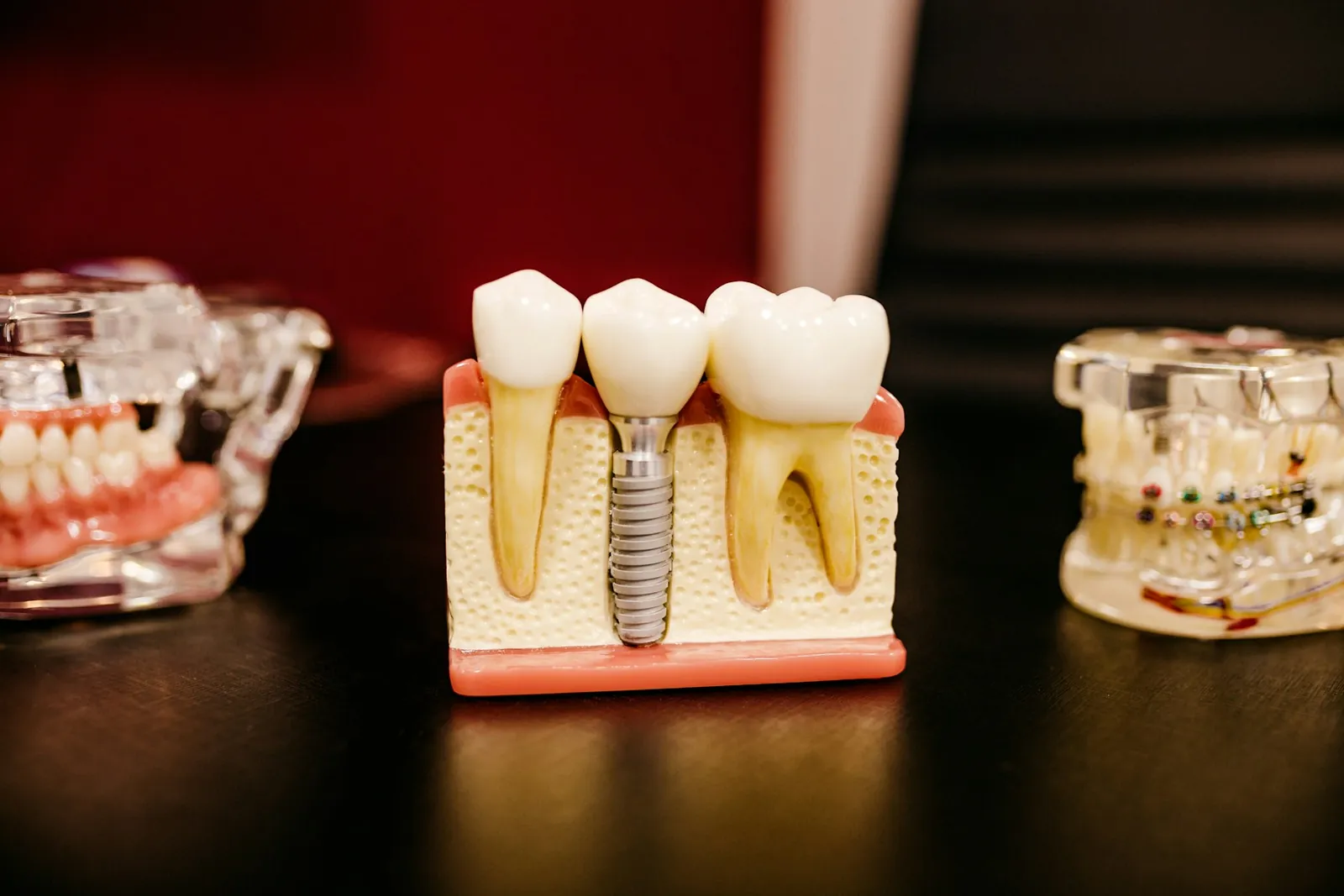Modelo de implante dentário com coroas
